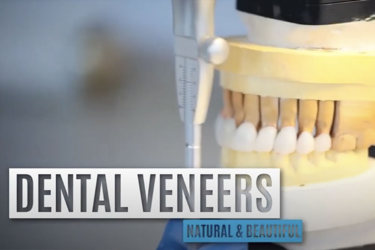 veneers in Sierra Madre