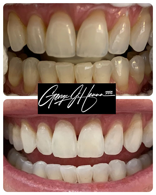 teeth-whitening-1