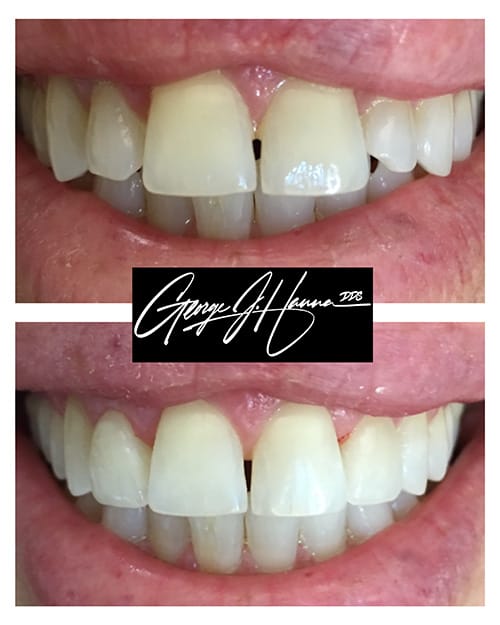 veneers and whitening