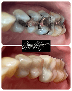 amalgam replace, same day inlays crowns