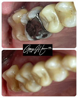 crown, amalgam replace, same day porcelain crown