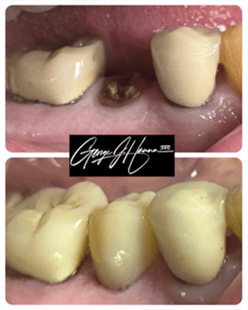 crown-before-and-after