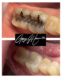 onlay, amalgam replace, same day porcelain onlays