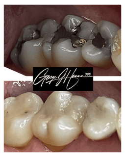 onlay, same day porcelain, alloy replacement