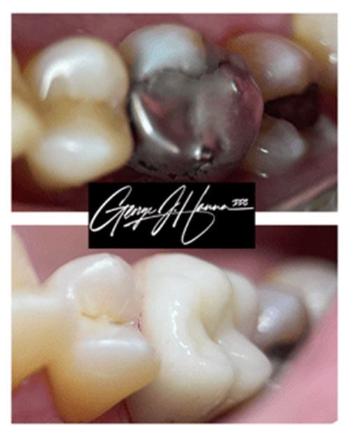 same-day-crown-replacing-alloy