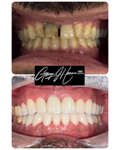 crowns-and-veneers