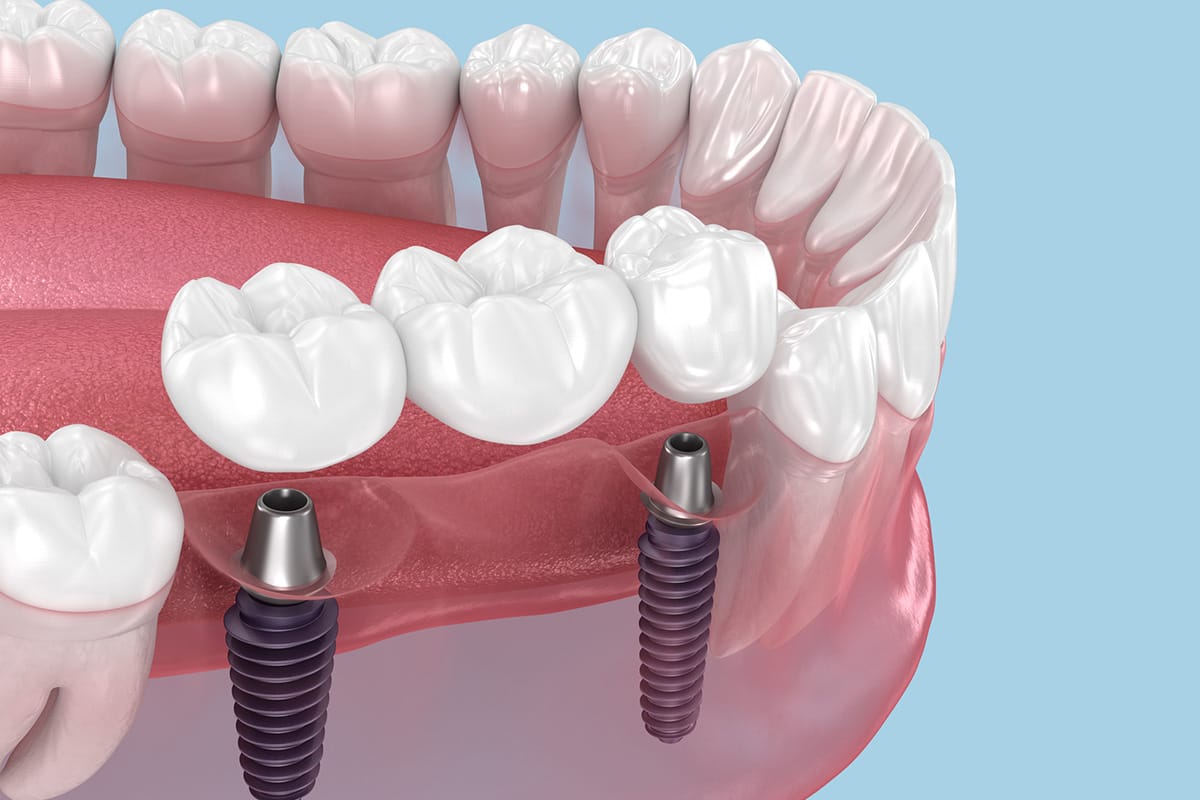 Multiple Tooth Implants in Sierra Madre, CA | Sierra Madre Dentistry